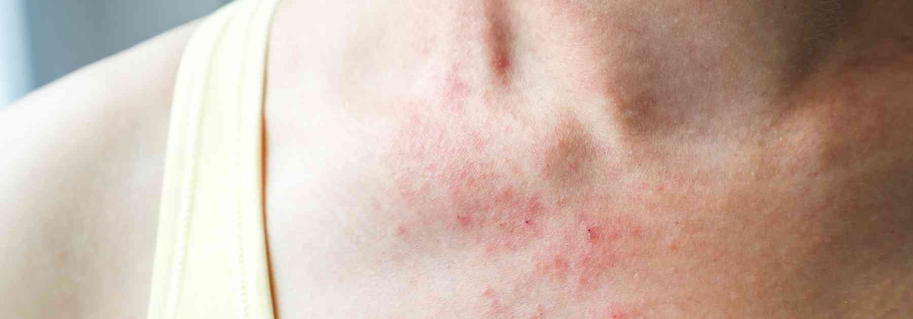 Impetigo rashes can be treated with cream