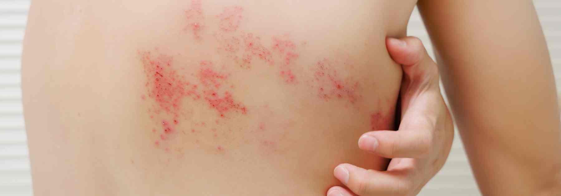 treat your rash with shingles NHS pharmacy first support