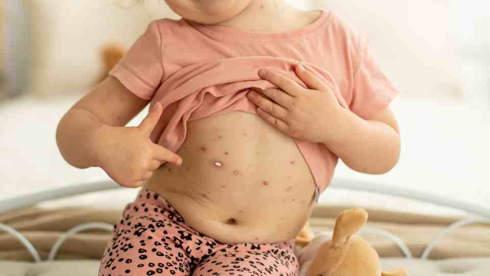 private chickenpox vaccine