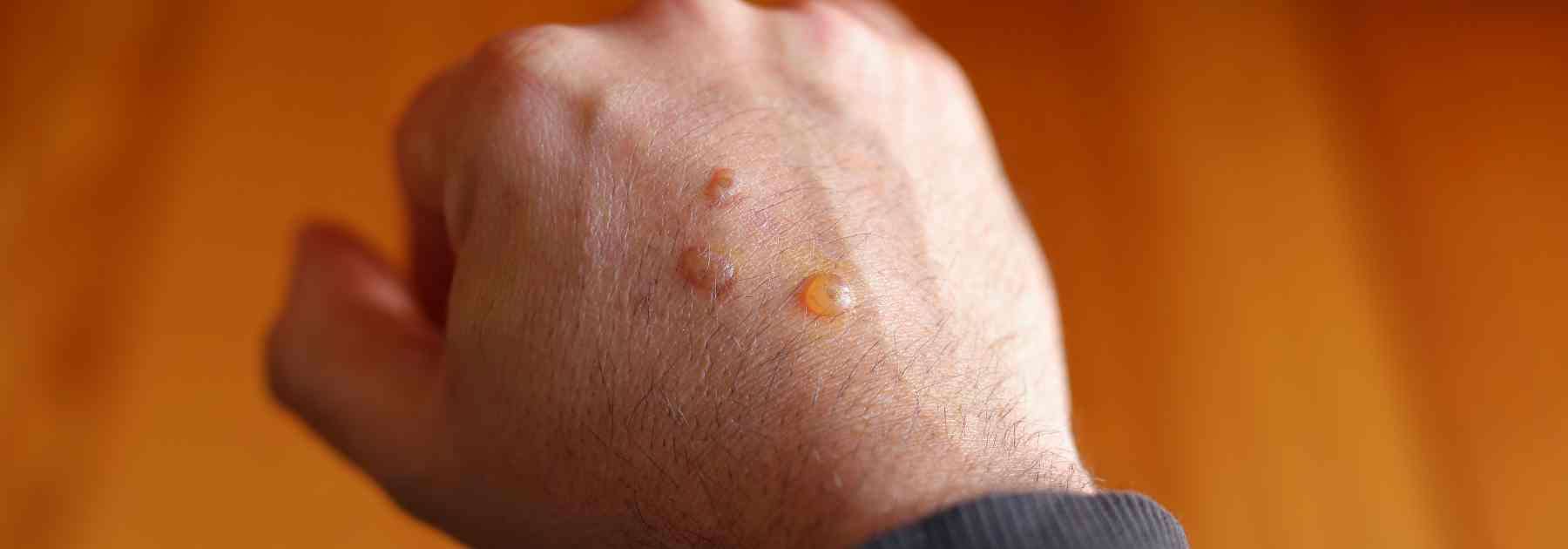 Treat 2nd degree burns in Devon. 