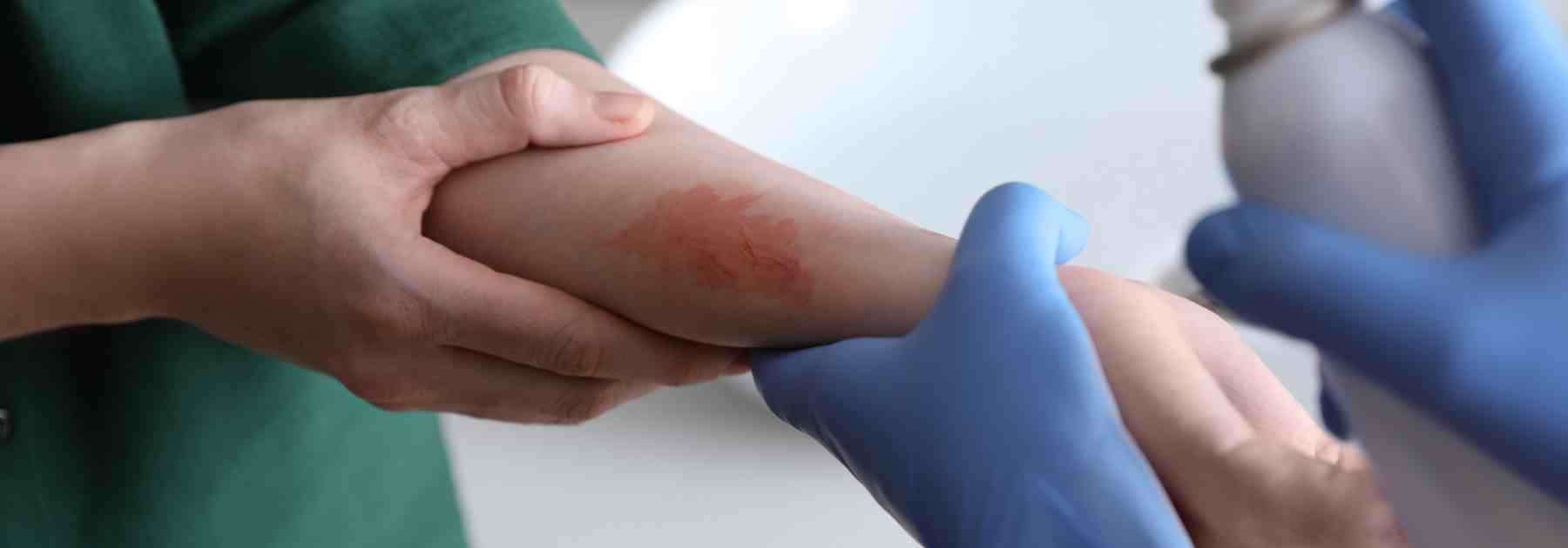 2nd degree burn treatment near me. 