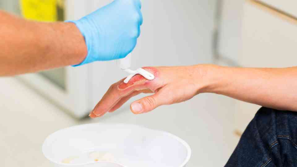 Can I get treatment for a 2nd degree burn through my local pharmacy?