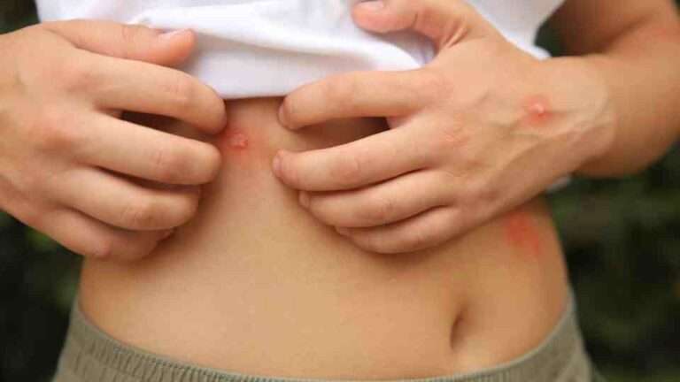 Pick the right insect bite cream for you.