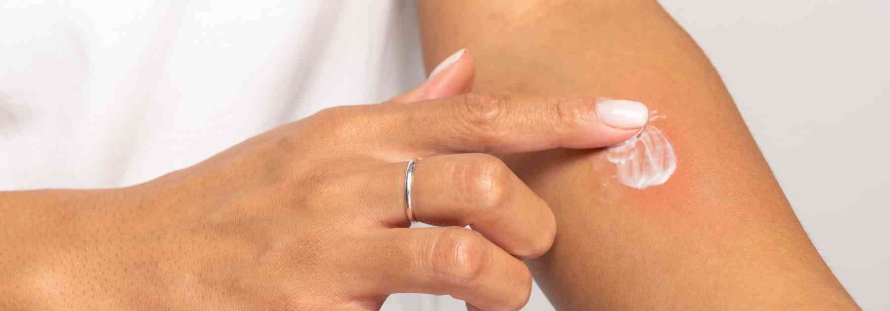 Choose the best insect bite cream.