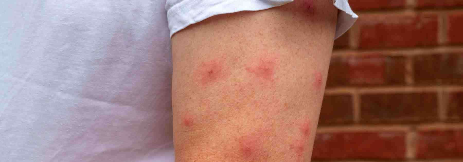 Buy insect bite cream in Devon.