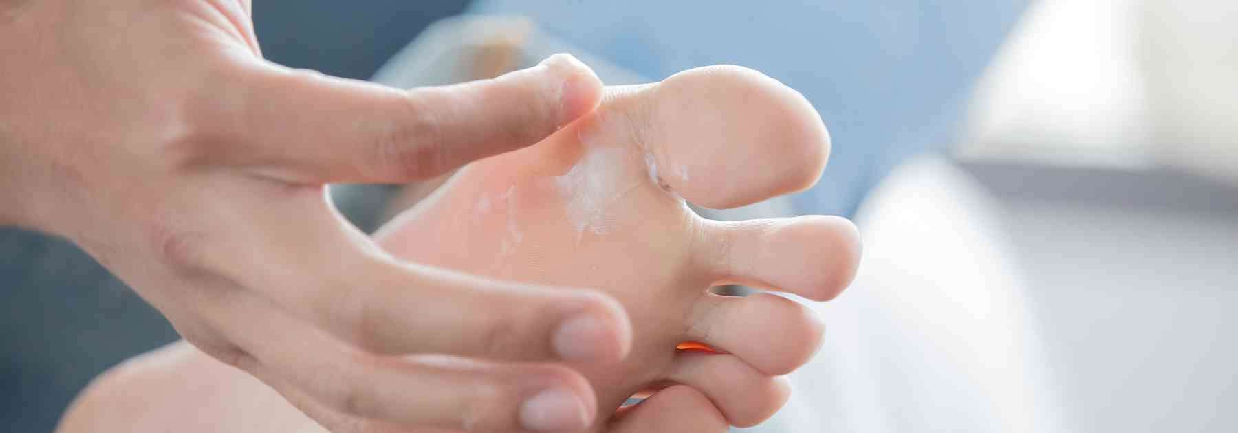 Buy athlete's foot cream. 